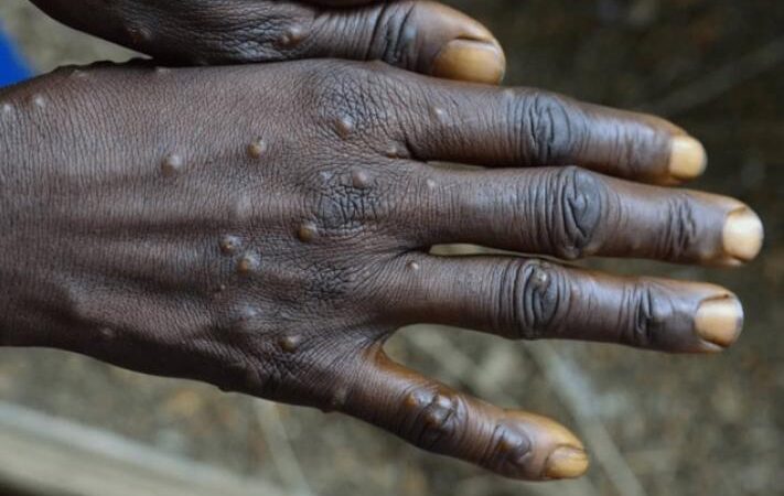 Un cas de variole du singe confirmé à Lomé : les autorités renforcent la vigilance