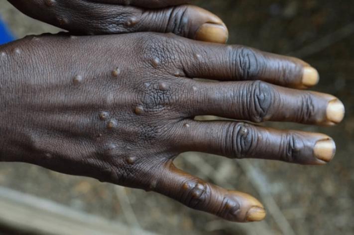 Un cas de variole du singe confirmé à Lomé : les autorités renforcent la vigilance